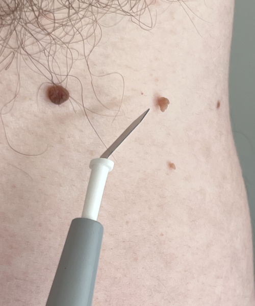 picture of a skin tag with the elecrocautery needle